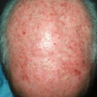 Solar keratoses.