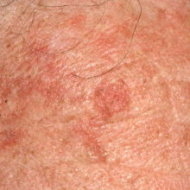 Solar keratoses.