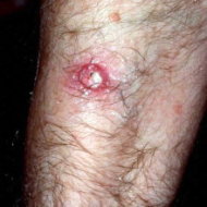 Squamous cell carcinoma.