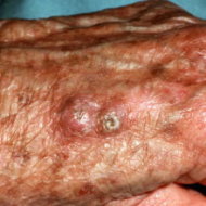 Squamous cell carcinoma.